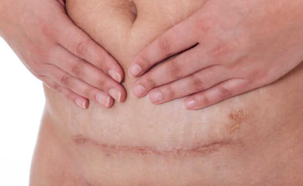 c-section scar, scarwork therapy